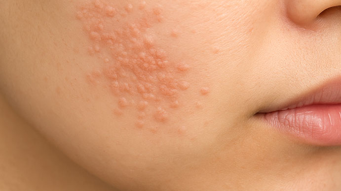 wart 편평 사마귀