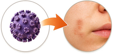 wart2 편평 사마귀 원인